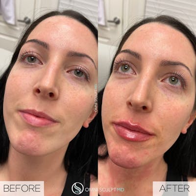 Lips Before & After Gallery - Patient 137695 - Image 1