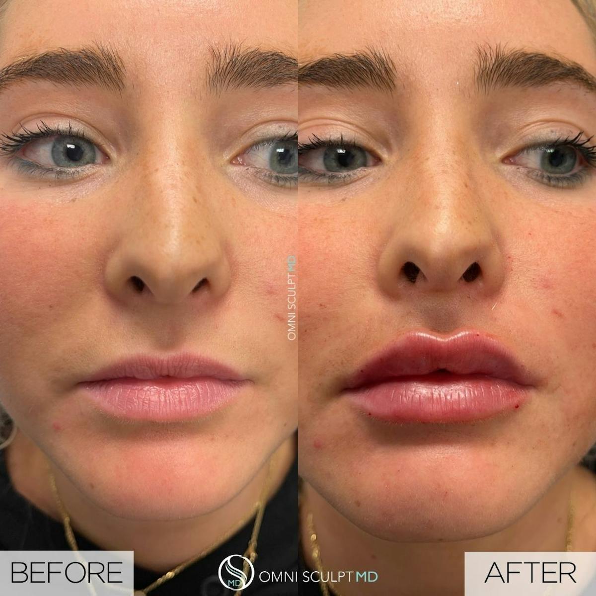Lips Before & After Gallery - Patient 912586 - Image 1