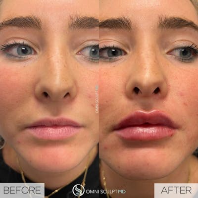 Lips Before & After Gallery - Patient 912586 - Image 1