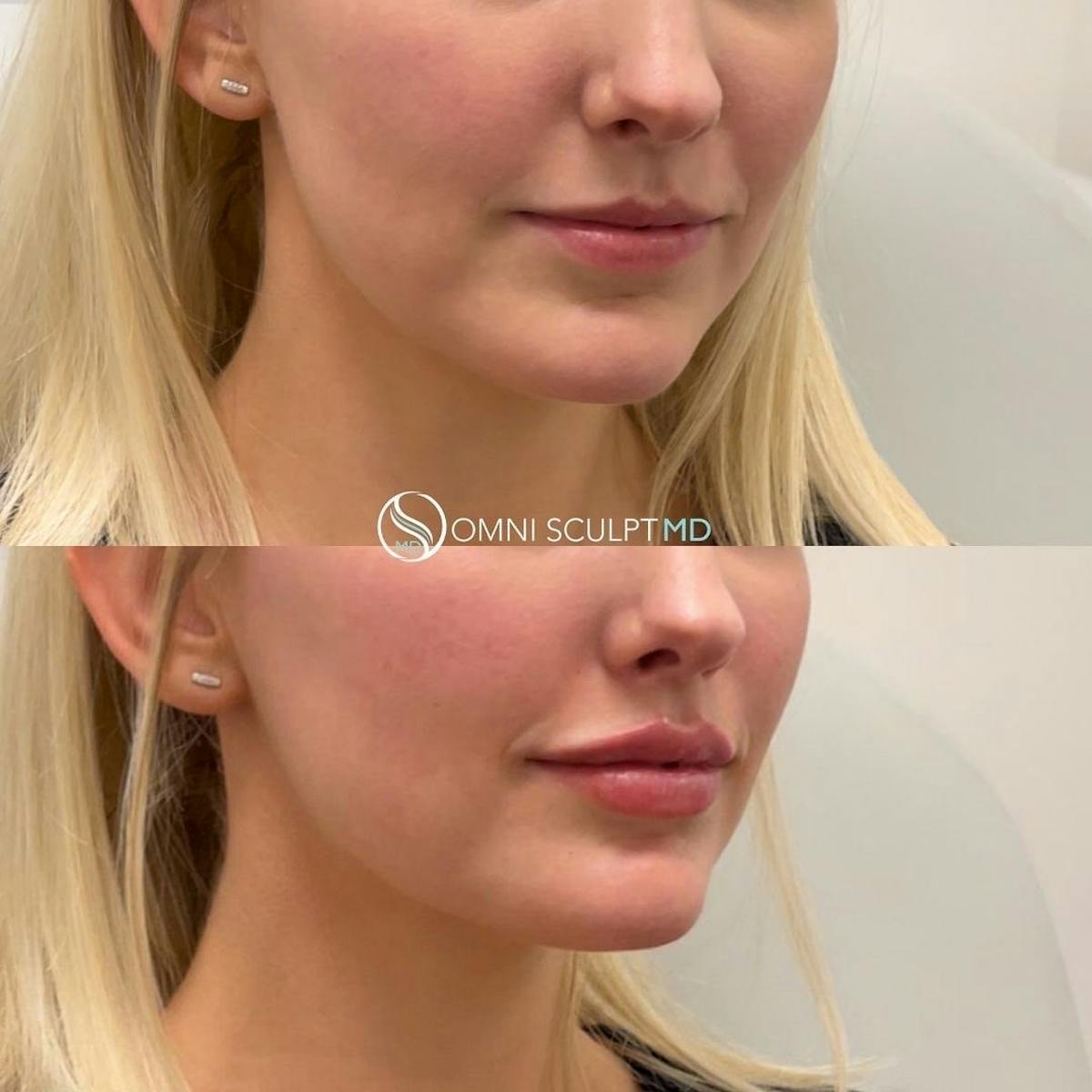 Lips Before & After Gallery - Patient 341087 - Image 1