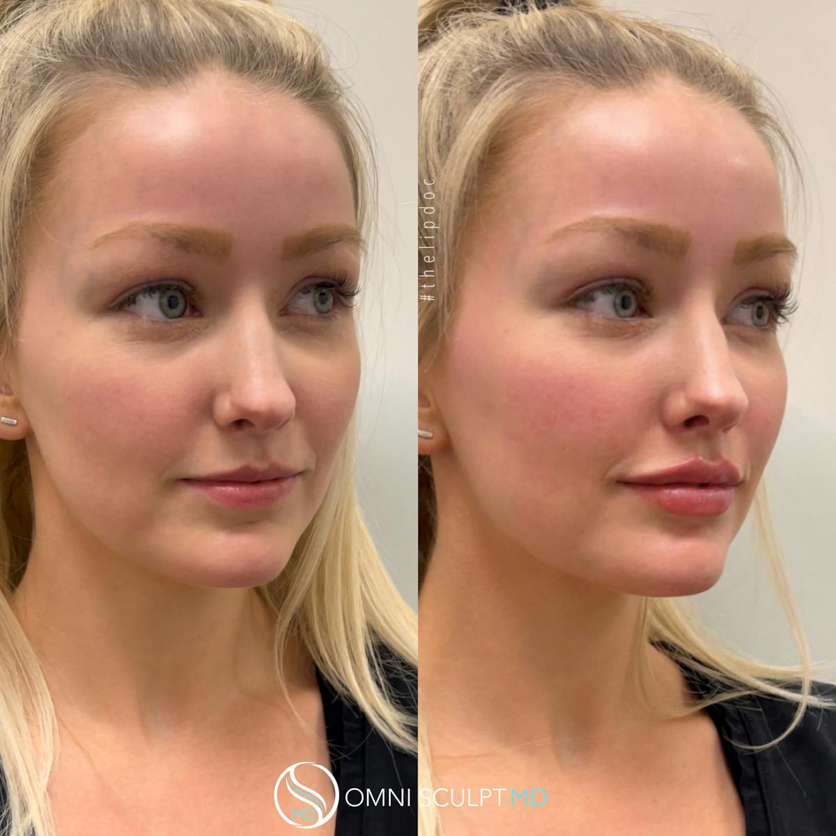 Lips Before & After Gallery - Patient 341087 - Image 2