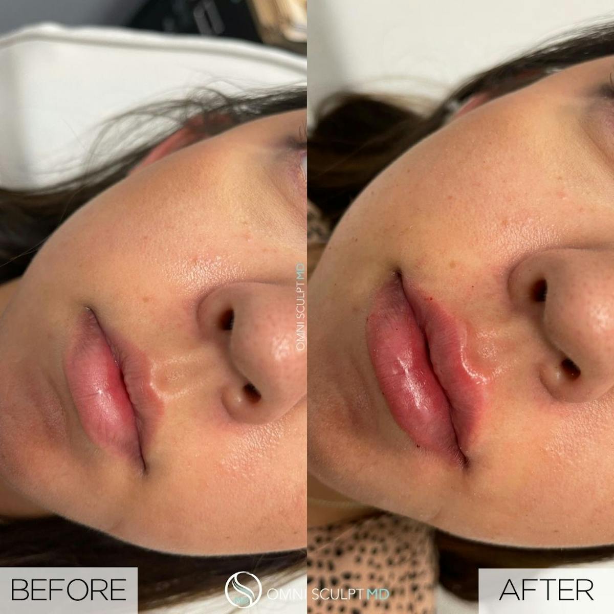 Lips Before & After Gallery - Patient 307786 - Image 1