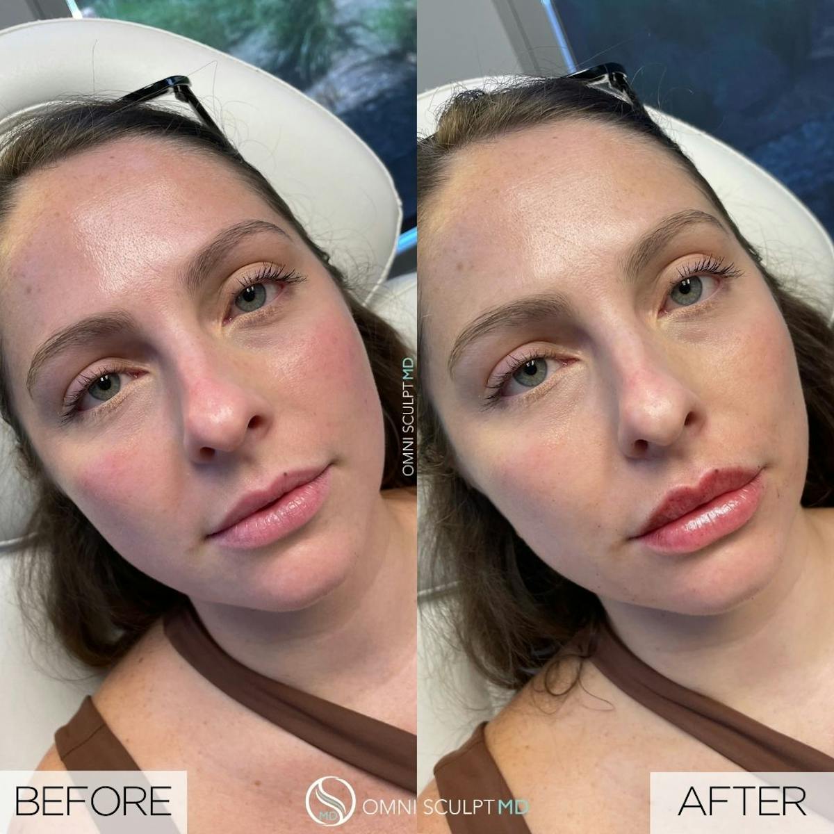 Lips Before & After Gallery - Patient 411887 - Image 1