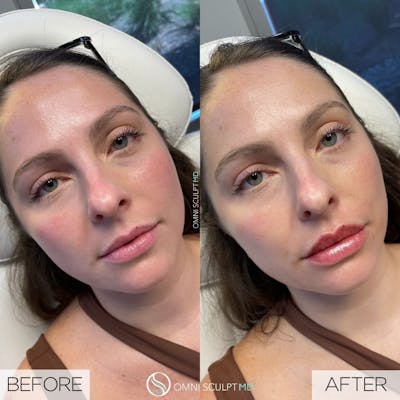 Lips Before & After Gallery - Patient 411887 - Image 1