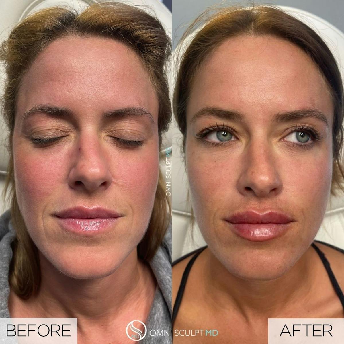 Lips Before & After Gallery - Patient 469919 - Image 1