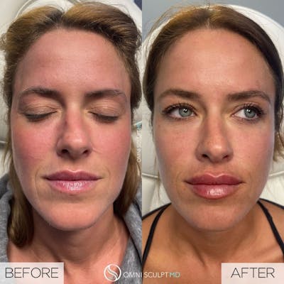 Lips Before & After Gallery - Patient 469919 - Image 1