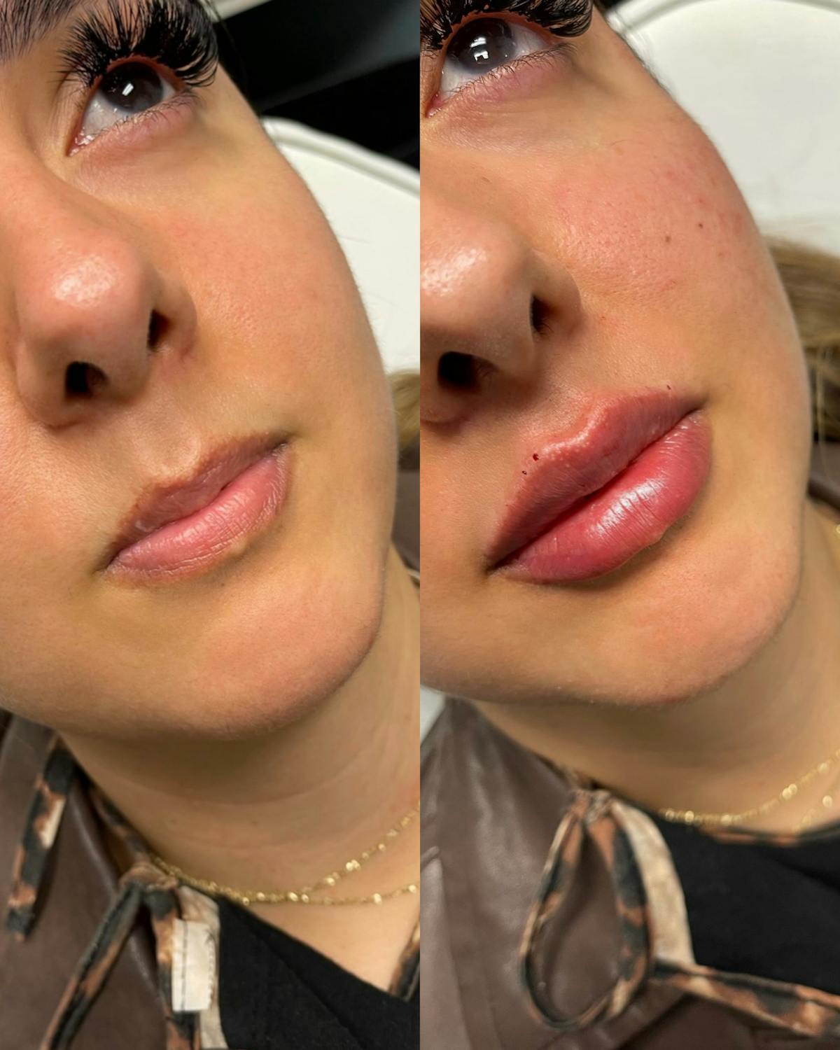 Lips Before & After Gallery - Patient 301627 - Image 1