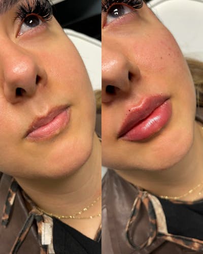 Lips Before & After Gallery - Patient 301627 - Image 1