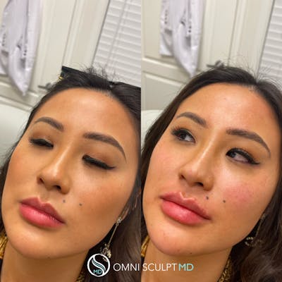 Lips Before & After Gallery - Patient 266176 - Image 1
