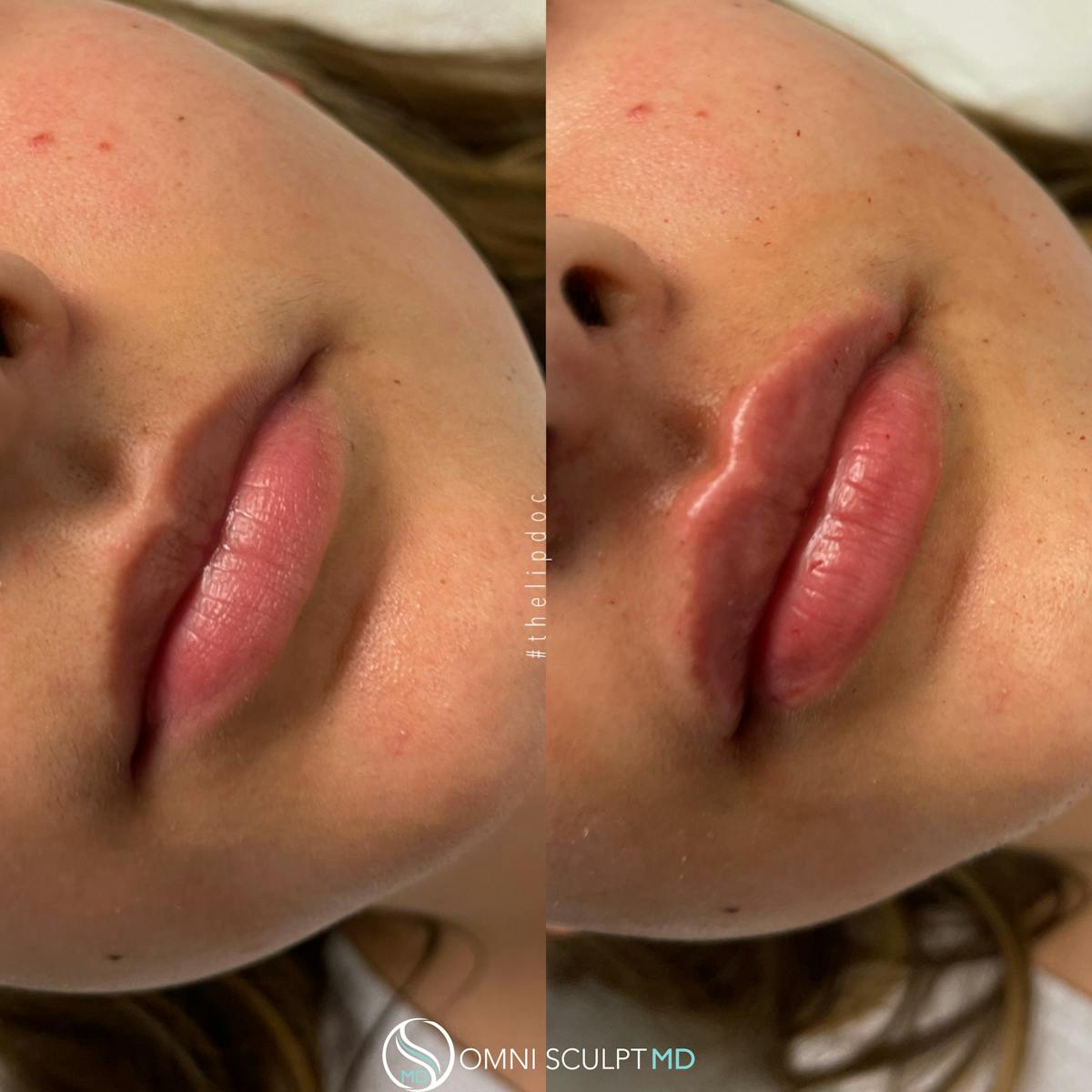 Lips Before & After Gallery - Patient 532590 - Image 1