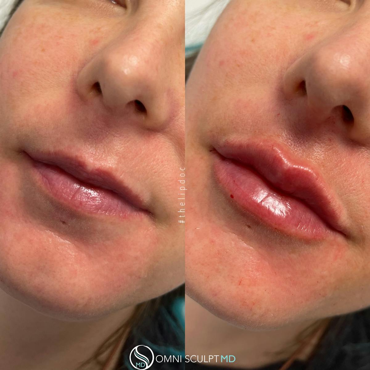 Lips Before & After Gallery - Patient 992561 - Image 1