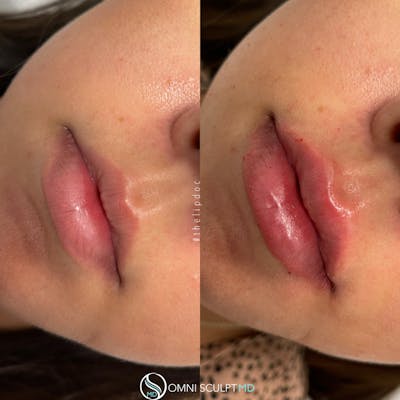Lips Before & After Gallery - Patient 354442 - Image 1