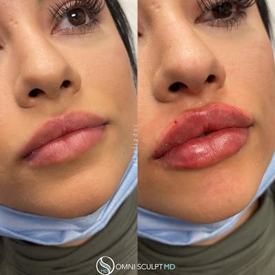 Lips Before & After Gallery - Patient 248117 - Image 1