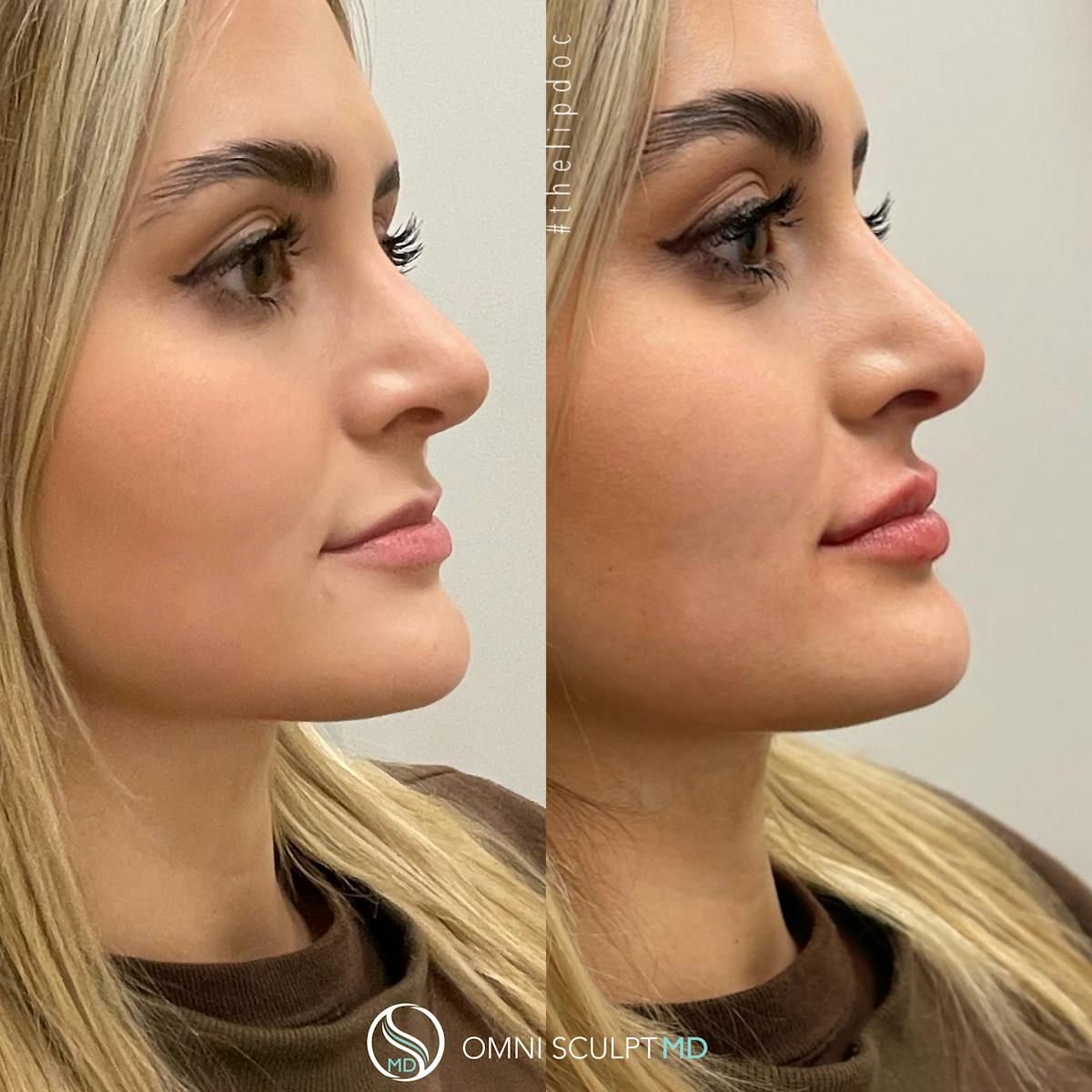 Lips Before & After Gallery - Patient 145800 - Image 1