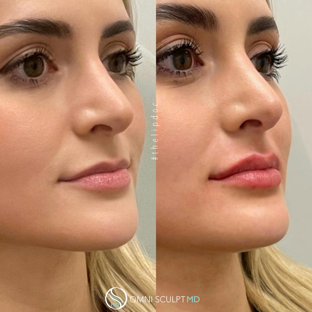 Lips Before & After Gallery - Patient 145800 - Image 2
