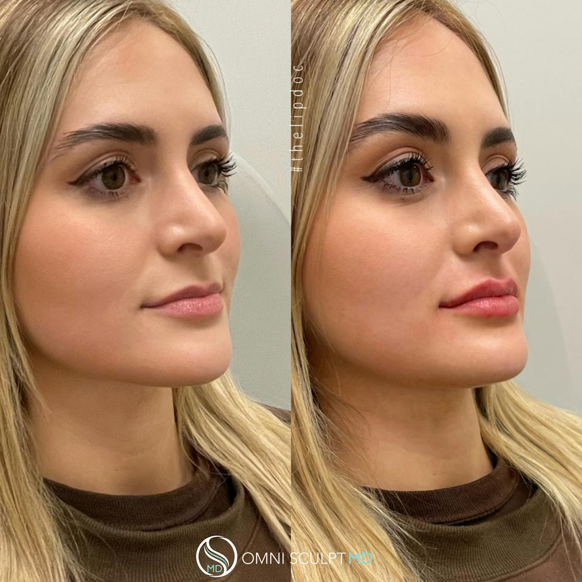 Lips Before & After Gallery - Patient 145800 - Image 3