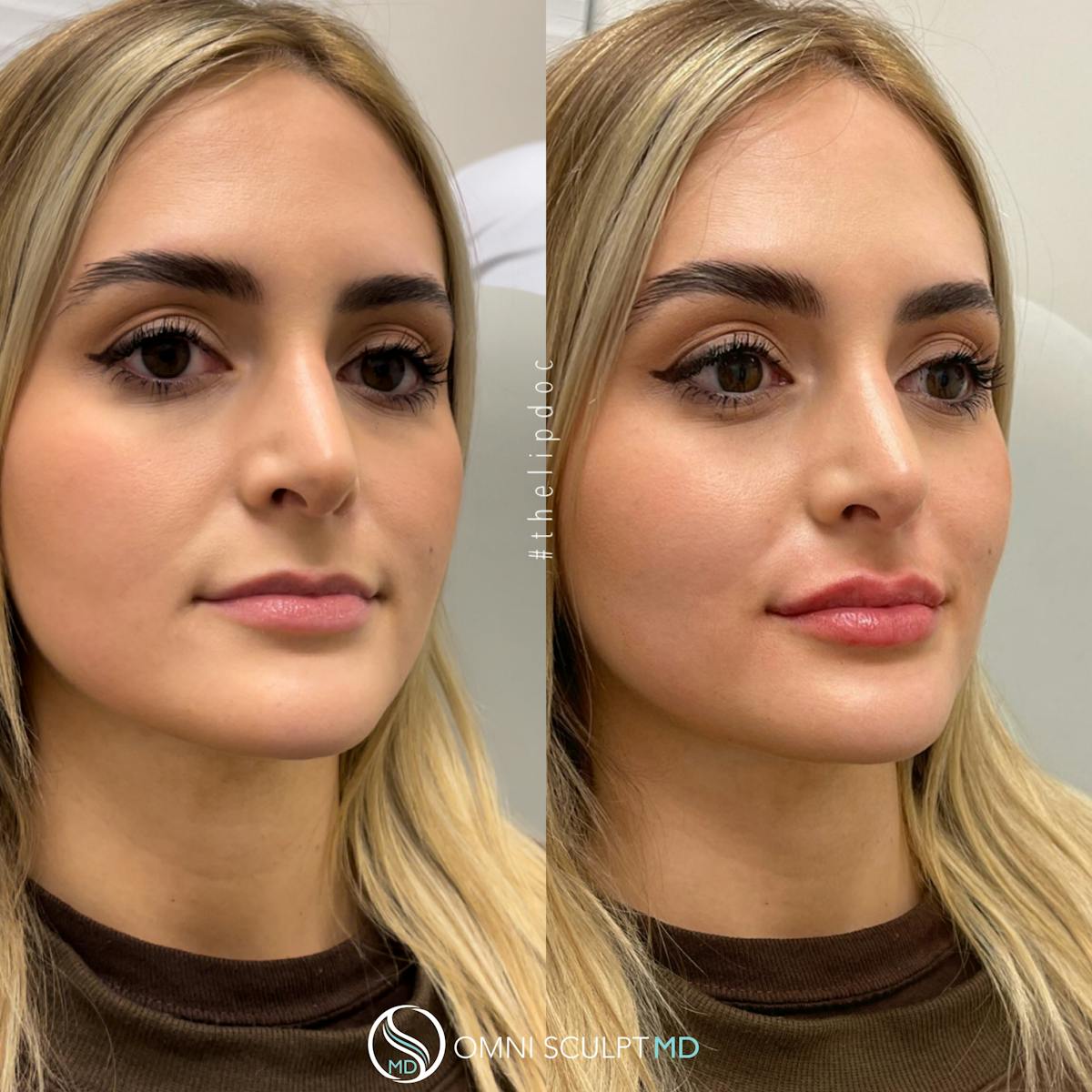 Lips Before & After Gallery - Patient 145800 - Image 5
