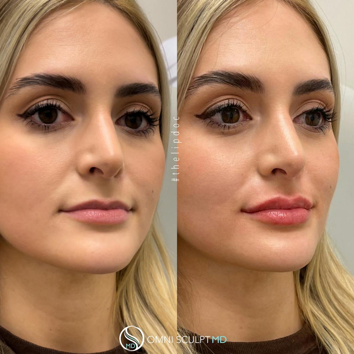 Lips Before & After Gallery - Patient 145800 - Image 6