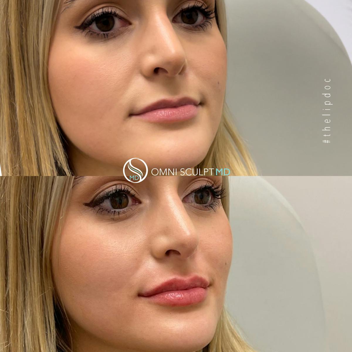 Lips Before & After Gallery - Patient 145800 - Image 7