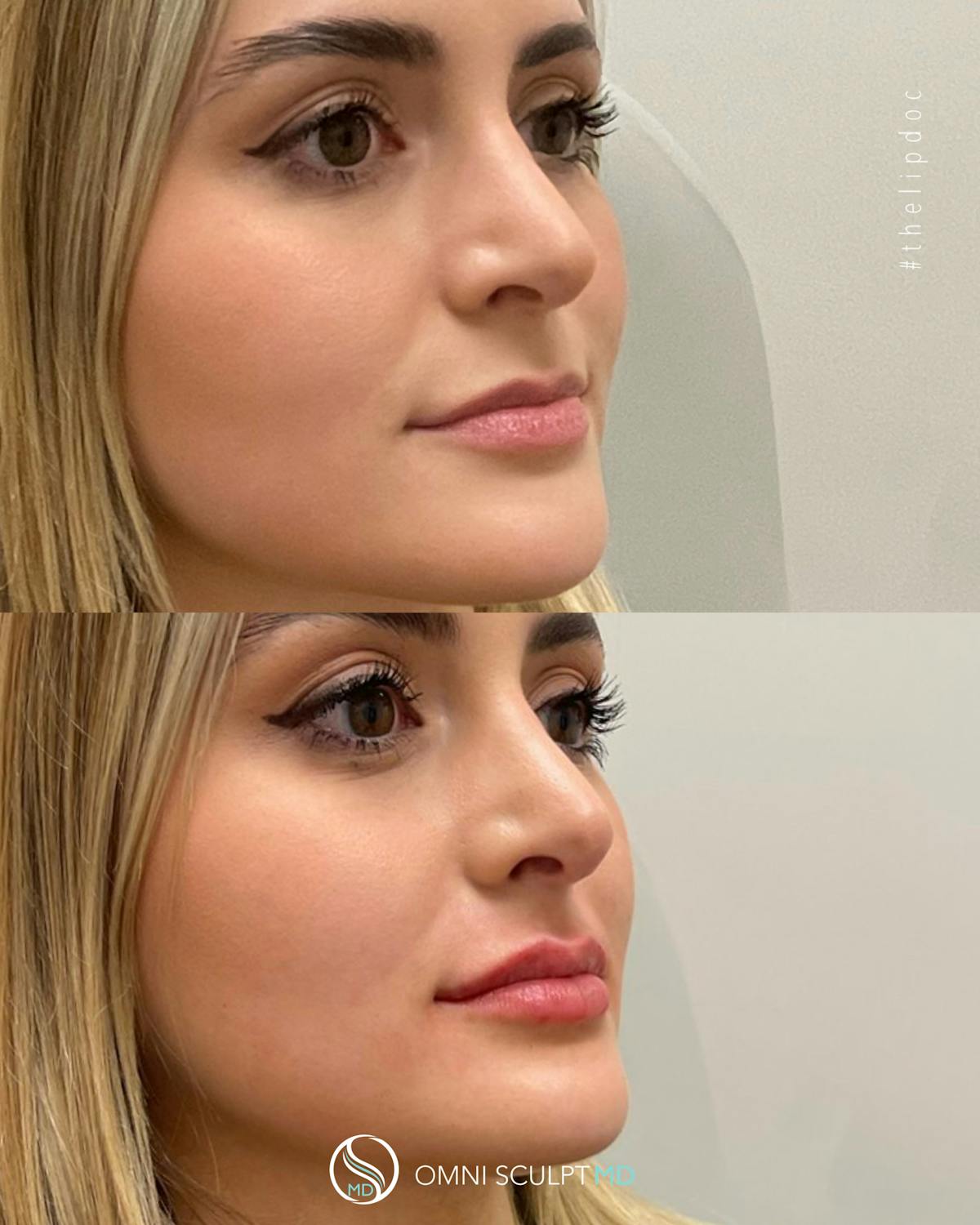 Lips Before & After Gallery - Patient 145800 - Image 8