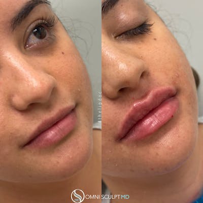 Lips Before & After Gallery - Patient 220379 - Image 1