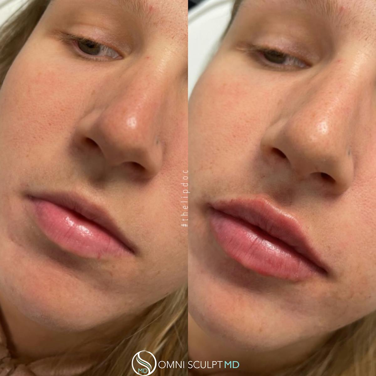 Lips Before & After Gallery - Patient 893321 - Image 1
