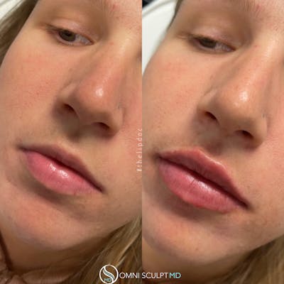 Lips Before & After Gallery - Patient 893321 - Image 1