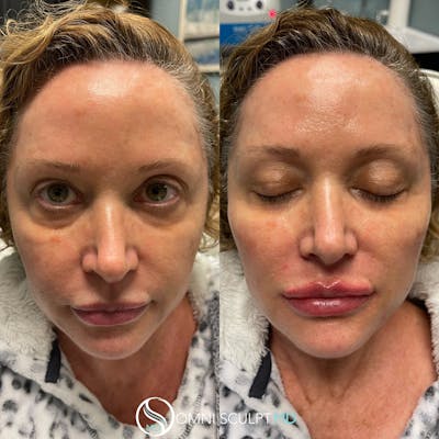 Lips Before & After Gallery - Patient 193215 - Image 1