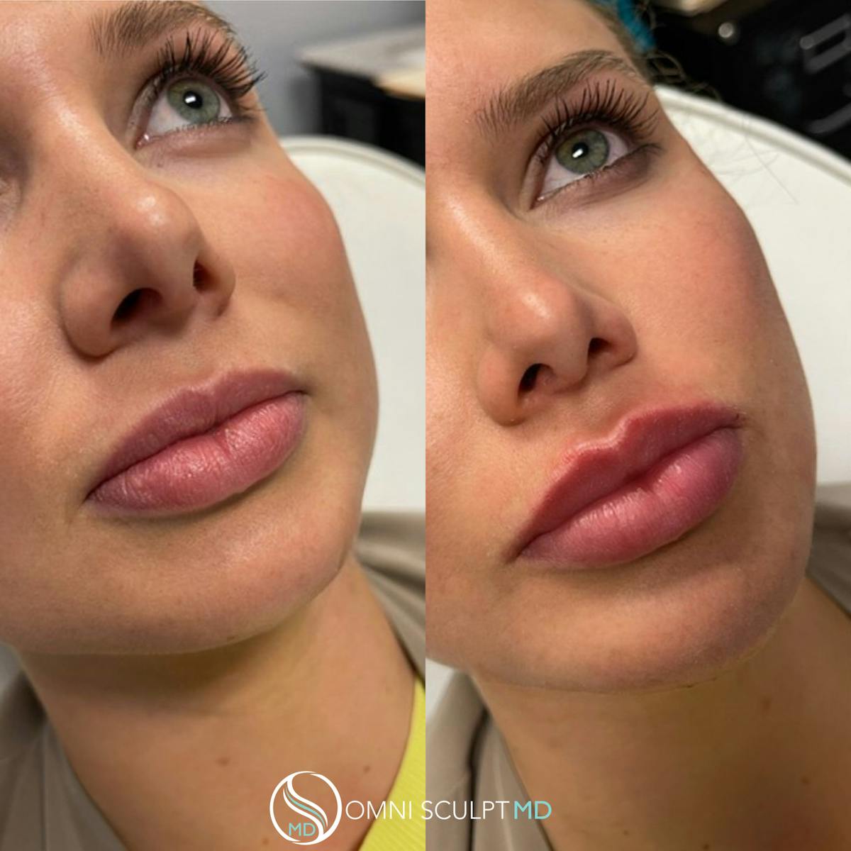 Lips Before & After Gallery - Patient 256878 - Image 1