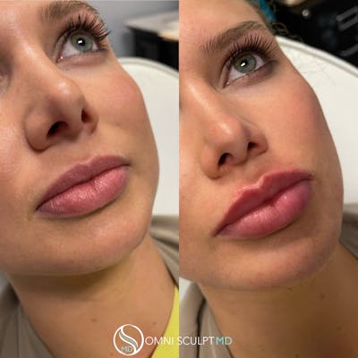 Lips Before & After Gallery - Patient 256878 - Image 1