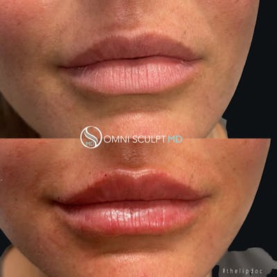 Lips Before & After Gallery - Patient 105235 - Image 1