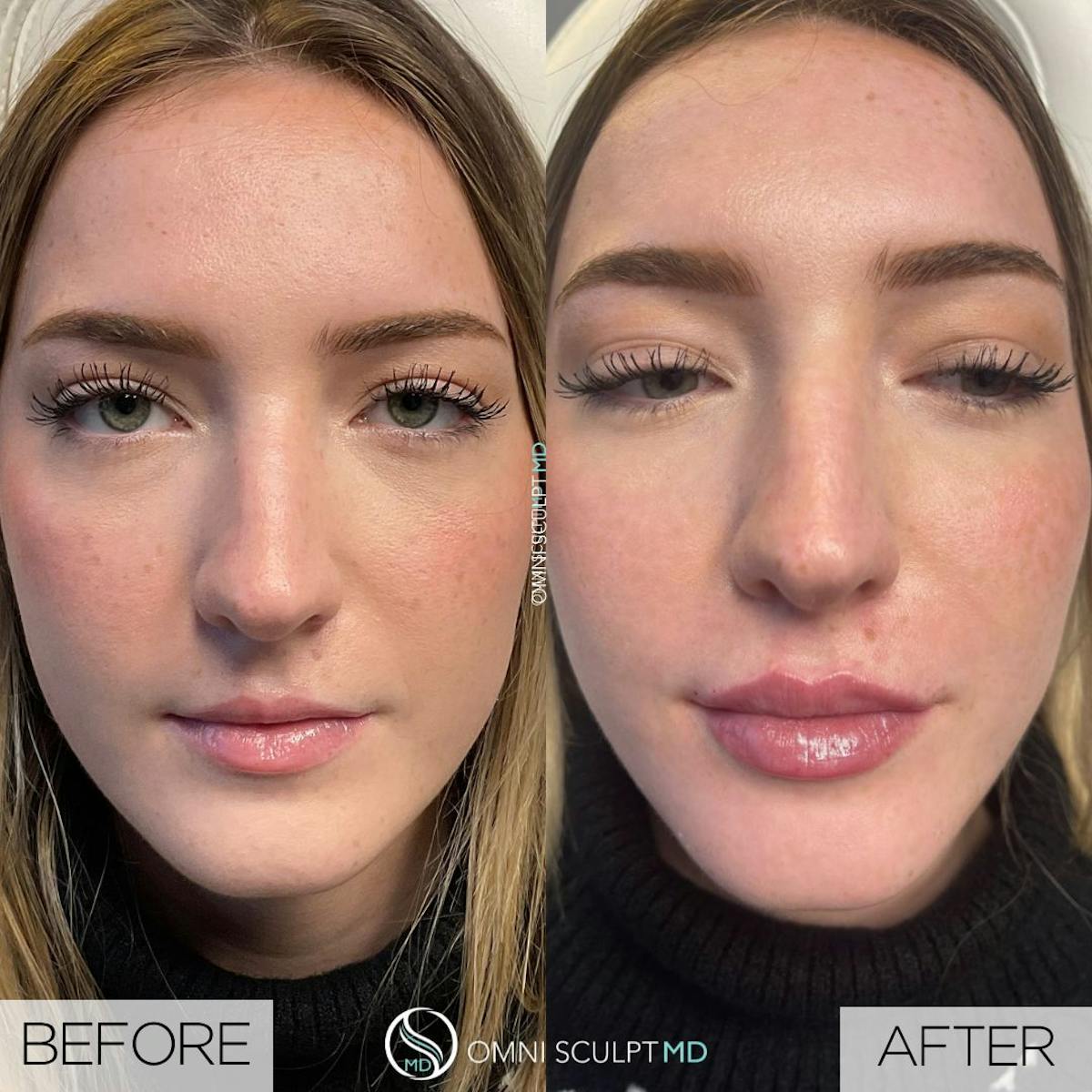 Lips Before & After Gallery - Patient 305852 - Image 1