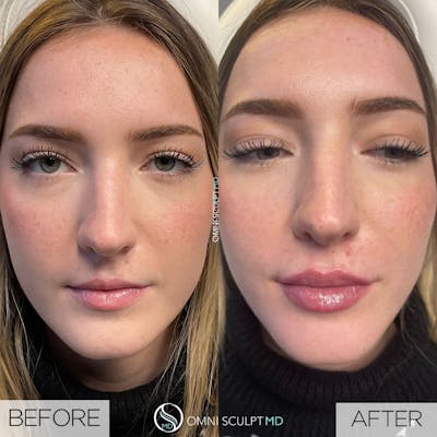 Lips Before & After Gallery - Patient 305852 - Image 1