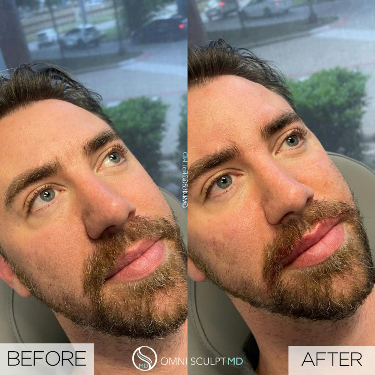 Lips Before & After Gallery - Patient 413257 - Image 1