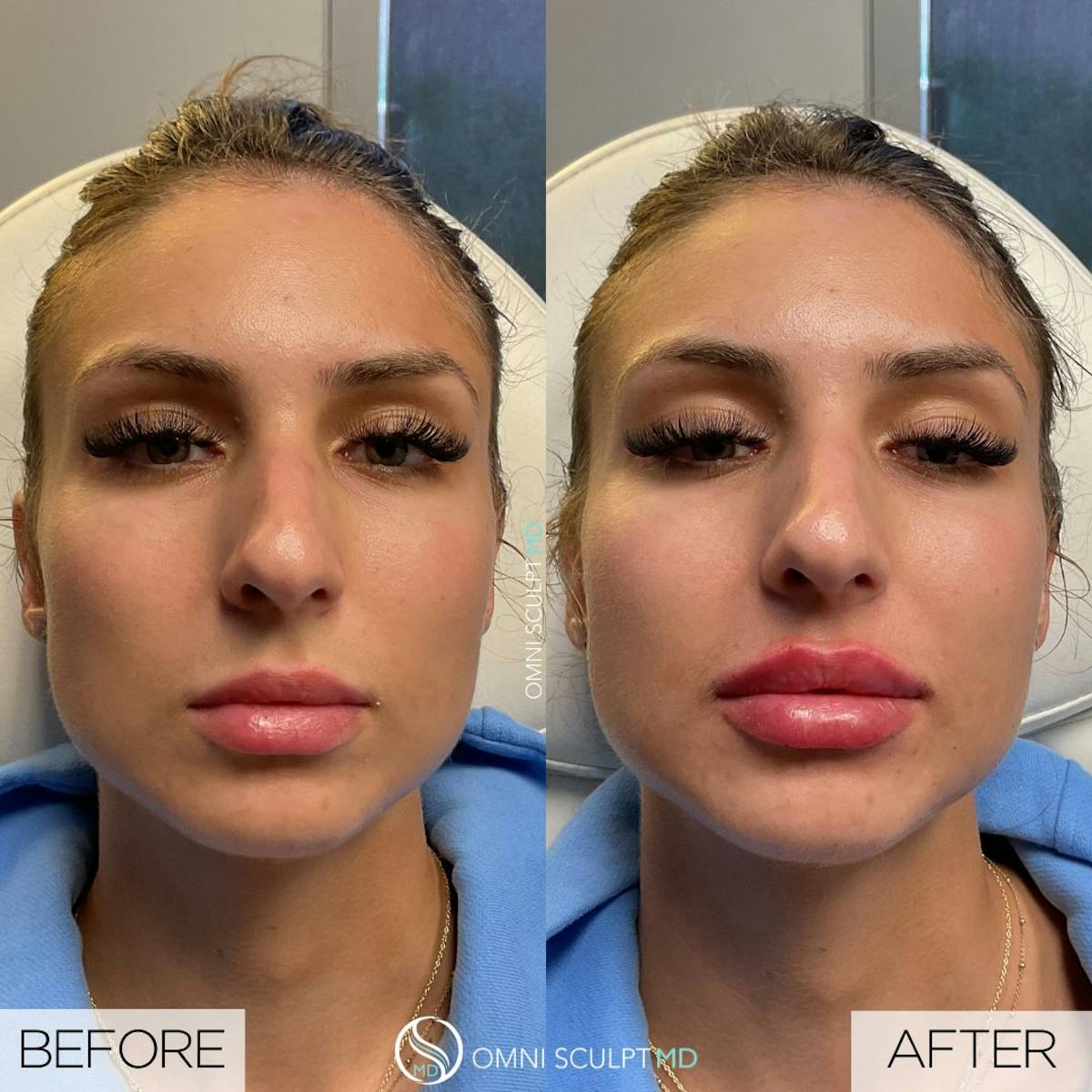 Lips Before & After Gallery - Patient 253613 - Image 1