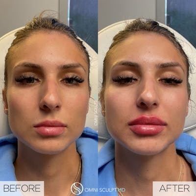 Lips Before & After Gallery - Patient 253613 - Image 1