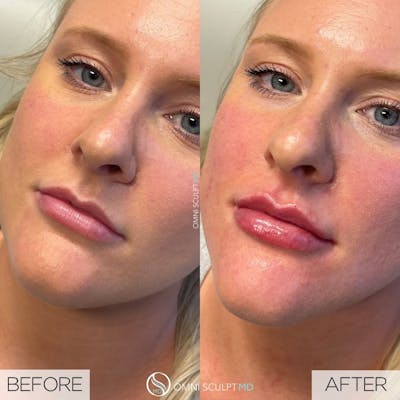 Lips Before & After Gallery - Patient 176554 - Image 1