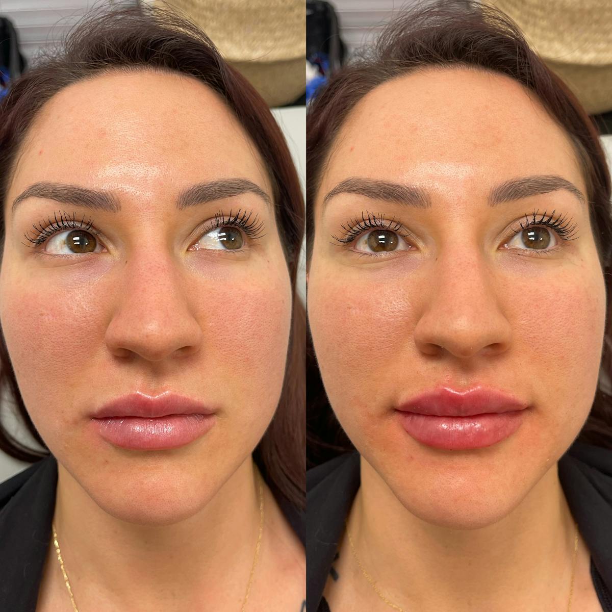 Lips Before & After Gallery - Patient 370473 - Image 1