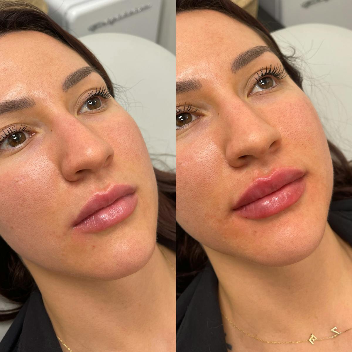 Lips Before & After Gallery - Patient 370473 - Image 2