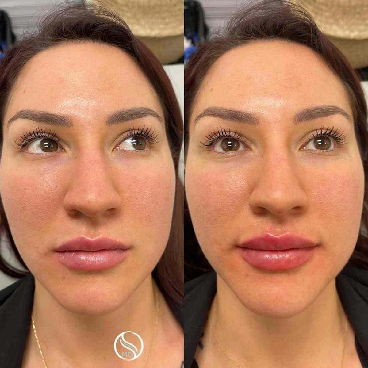 Lips Before & After Gallery - Patient 370473 - Image 3
