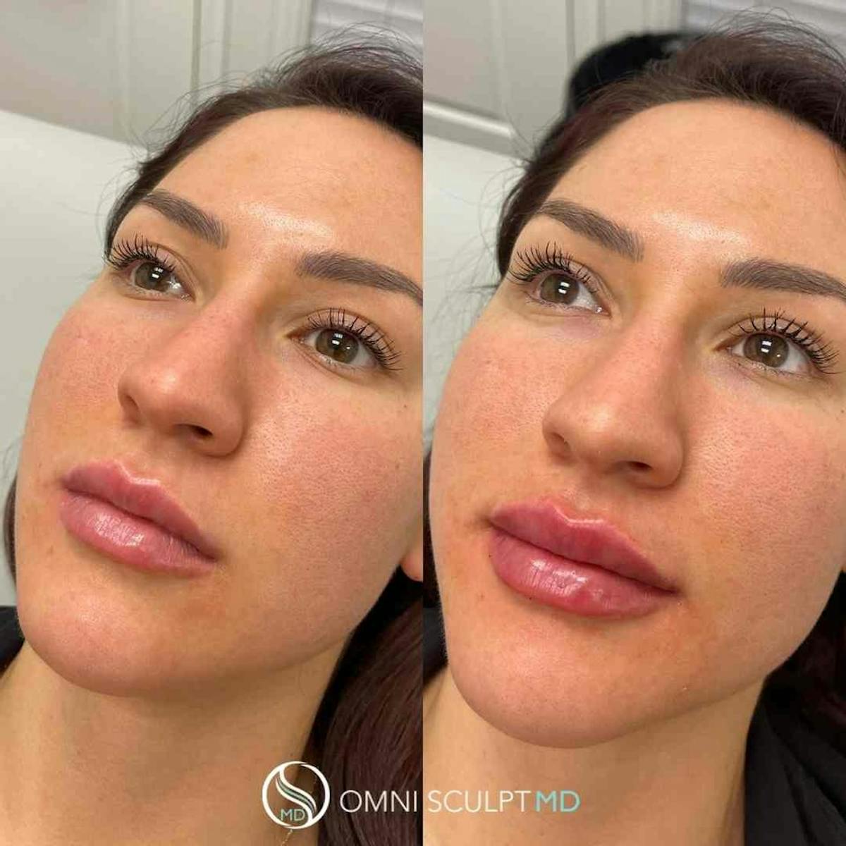 Lips Before & After Gallery - Patient 370473 - Image 4