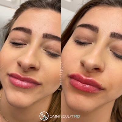 Lips Before & After Gallery - Patient 399340 - Image 1