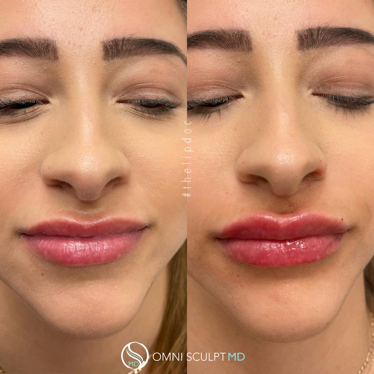 Lips Before & After Gallery - Patient 399340 - Image 2