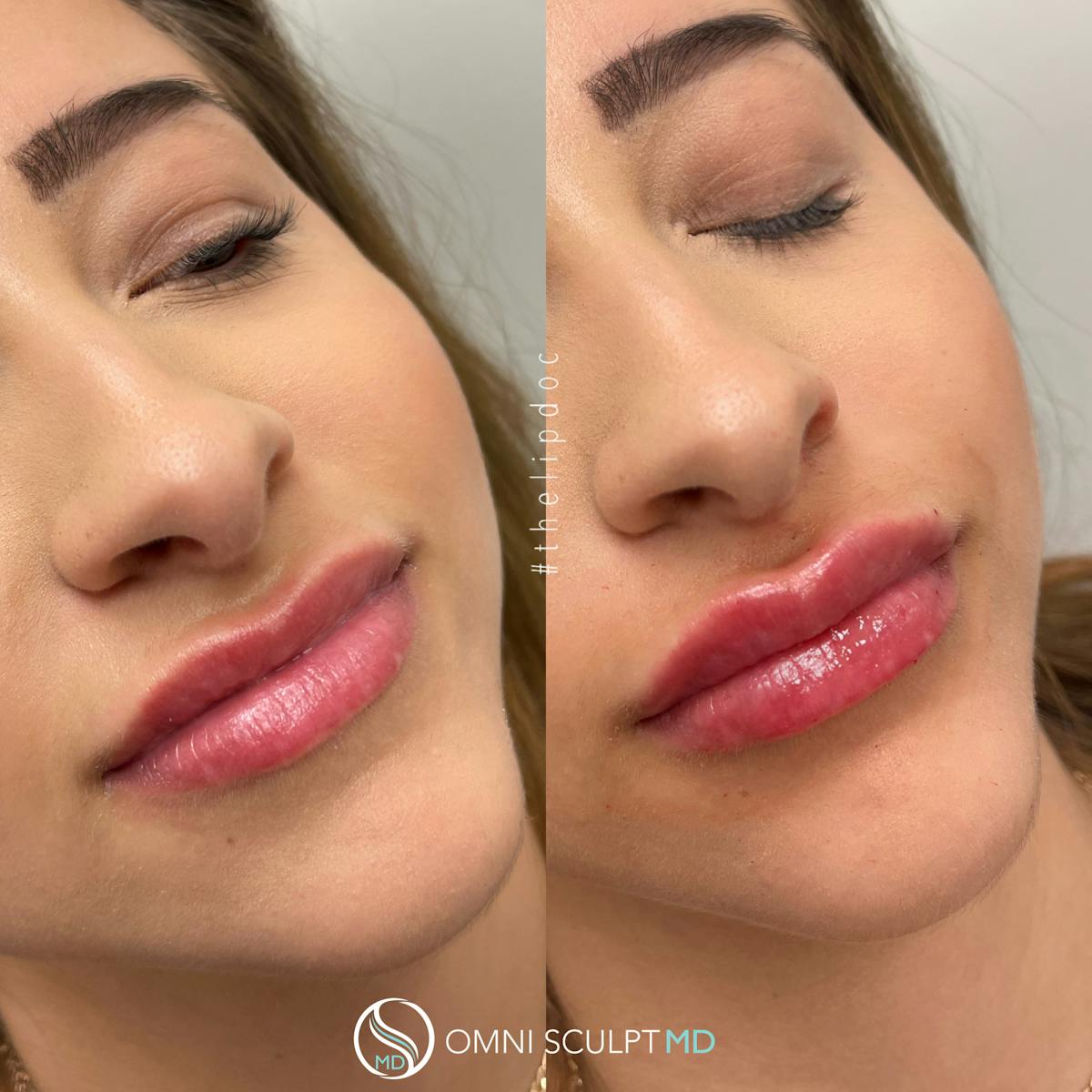 Lips Before & After Gallery - Patient 399340 - Image 3