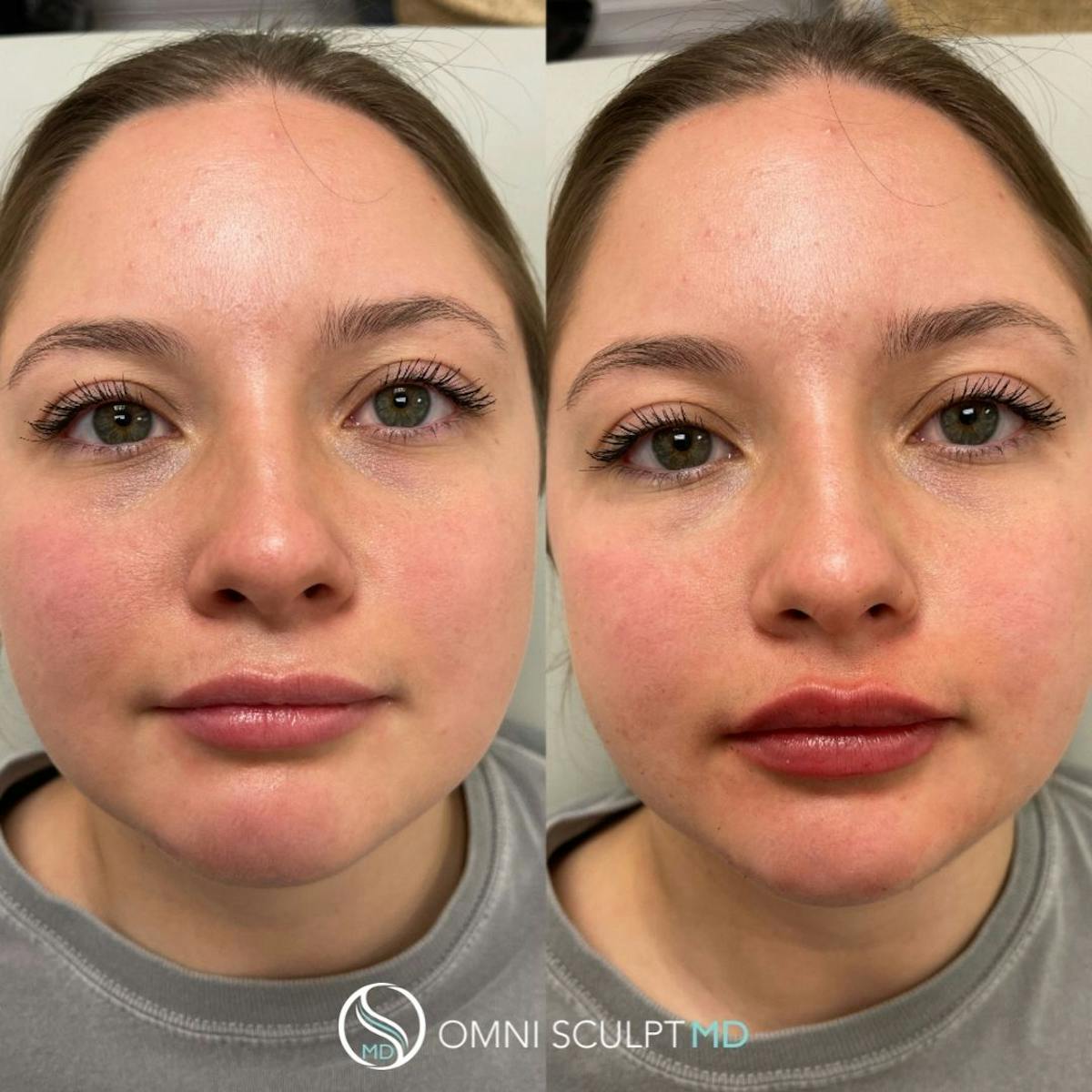 Lips Before & After Gallery - Patient 672577 - Image 1