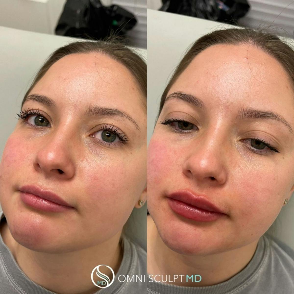 Lips Before & After Gallery - Patient 672577 - Image 2