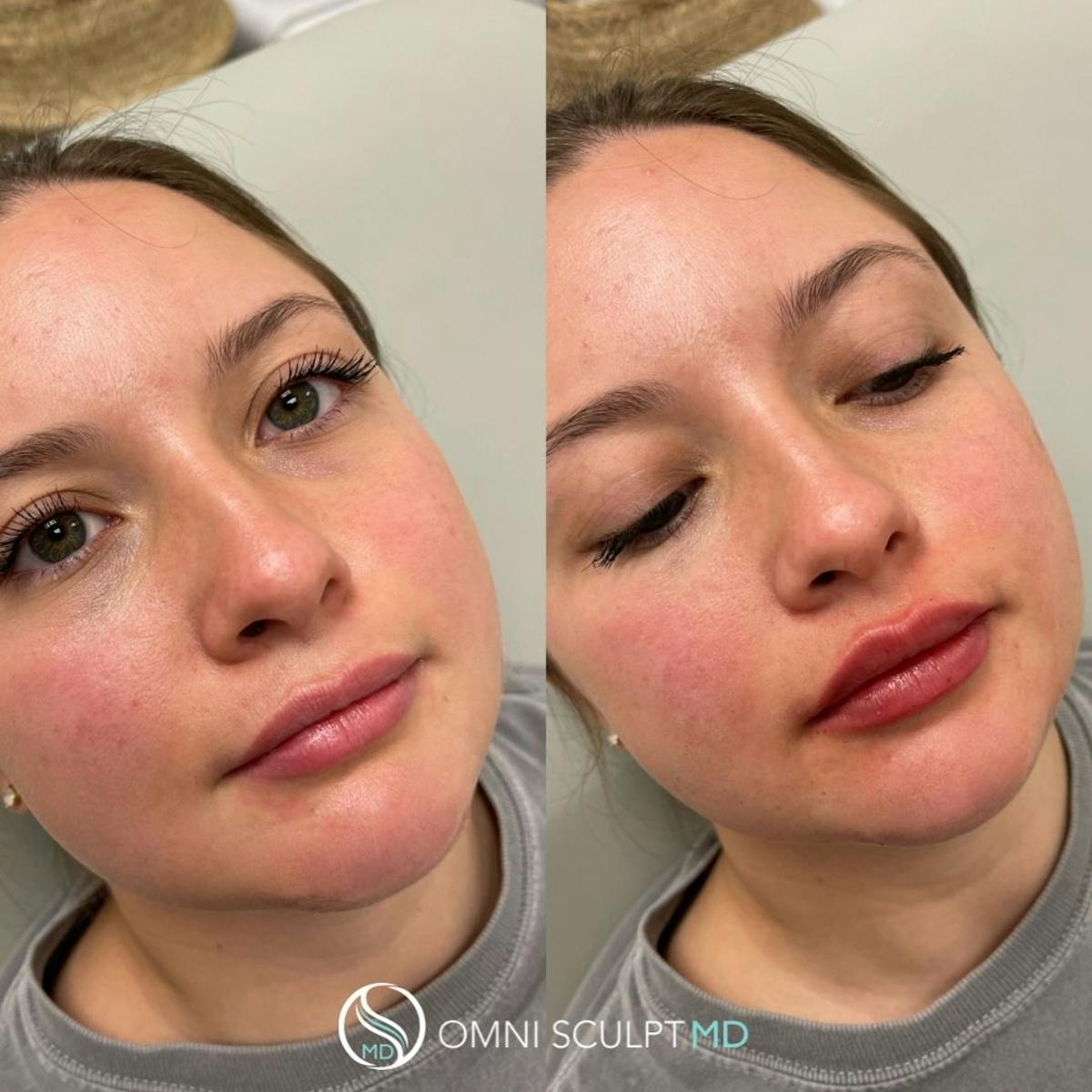 Lips Before & After Gallery - Patient 672577 - Image 3