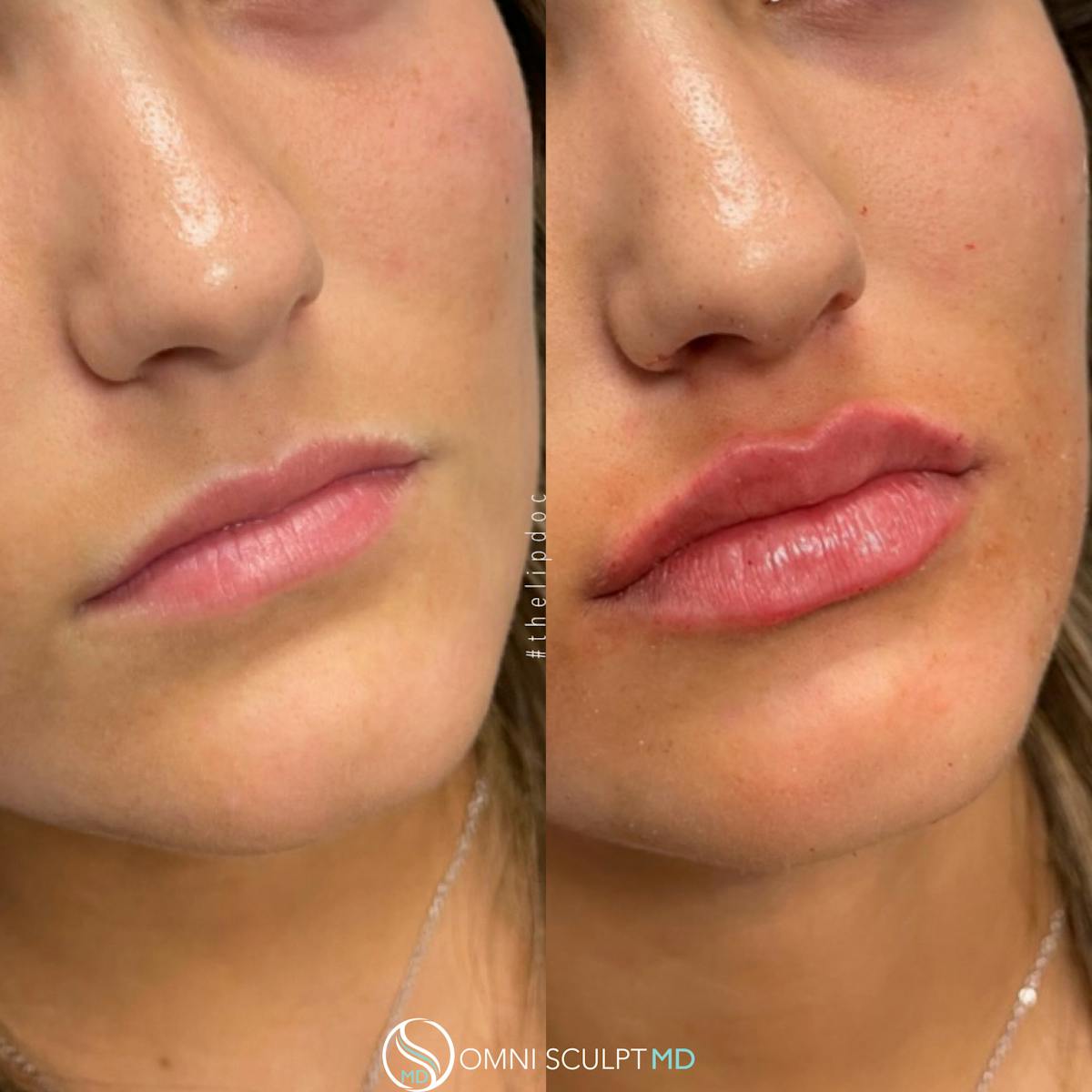 Lips Before & After Gallery - Patient 822743 - Image 1