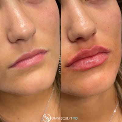 Lips Before & After Gallery - Patient 822743 - Image 1