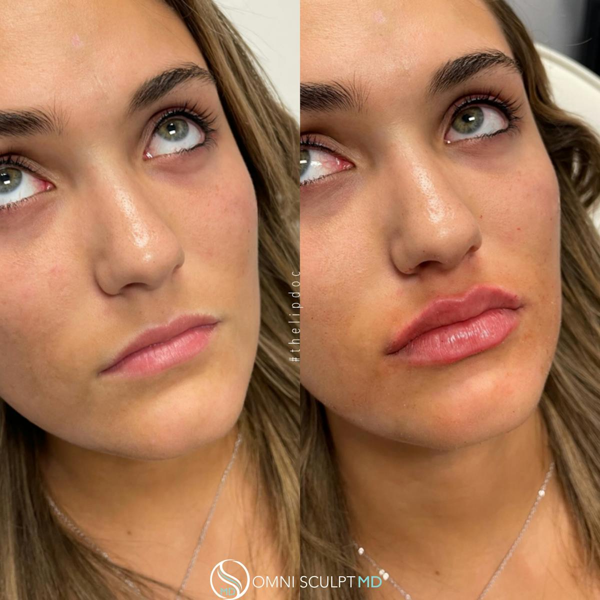 Lips Before & After Gallery - Patient 822743 - Image 2